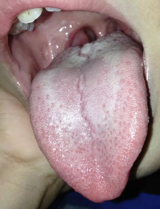 舌头代表宝宝身体内部的症状!