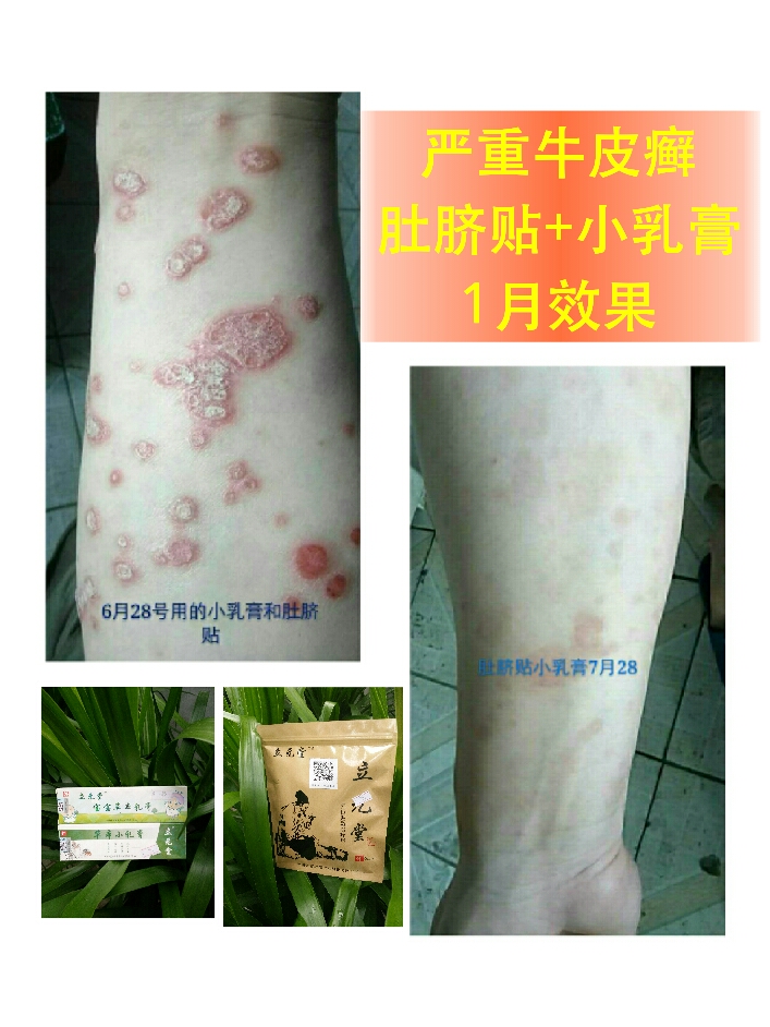 牛皮癣的治疗,是难题吗no