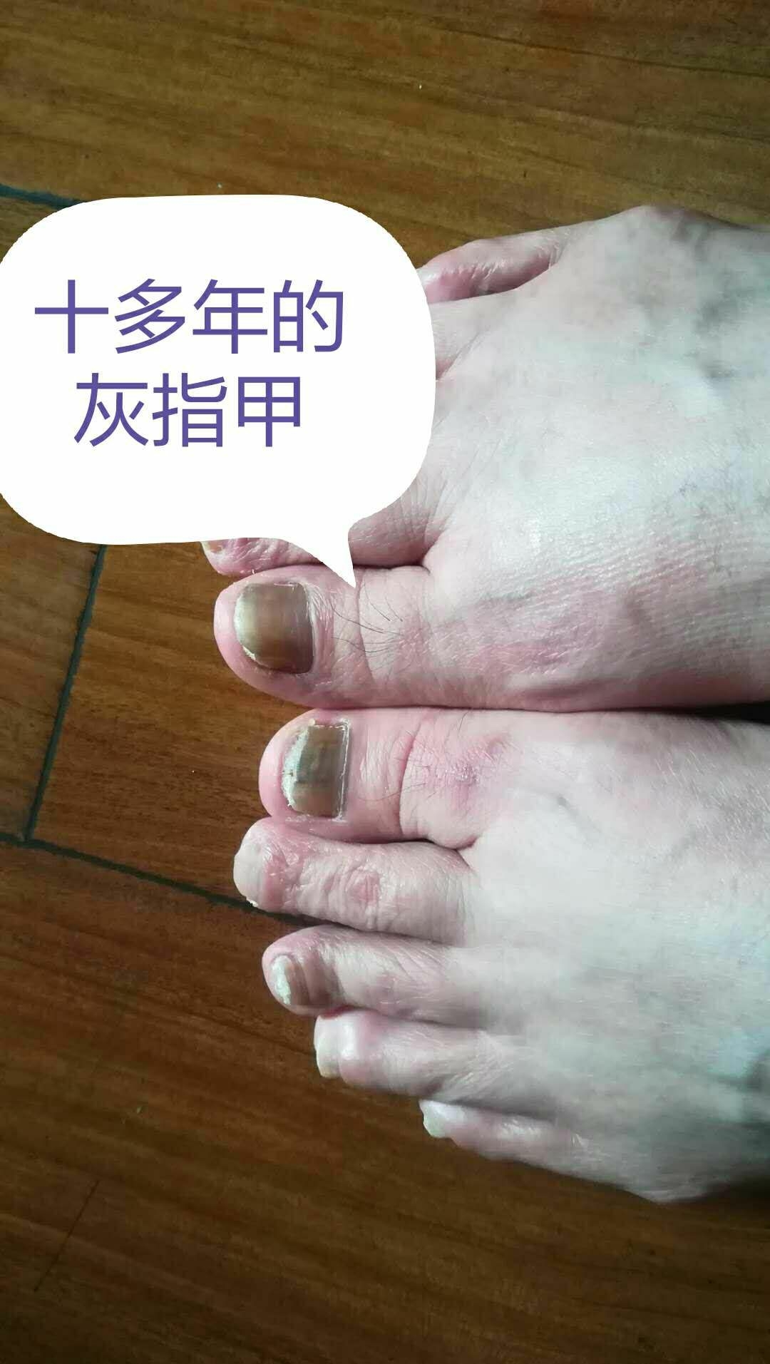 上海《灰指甲康复案例》