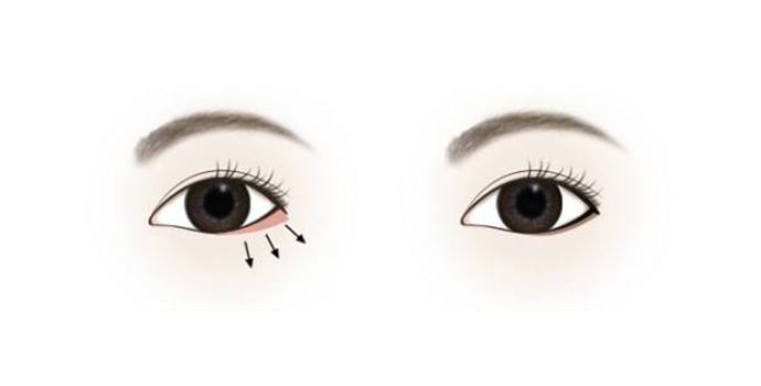 我在贵阳,想做眼睑下至多少钱?【贵州省第二人民医院整形科】