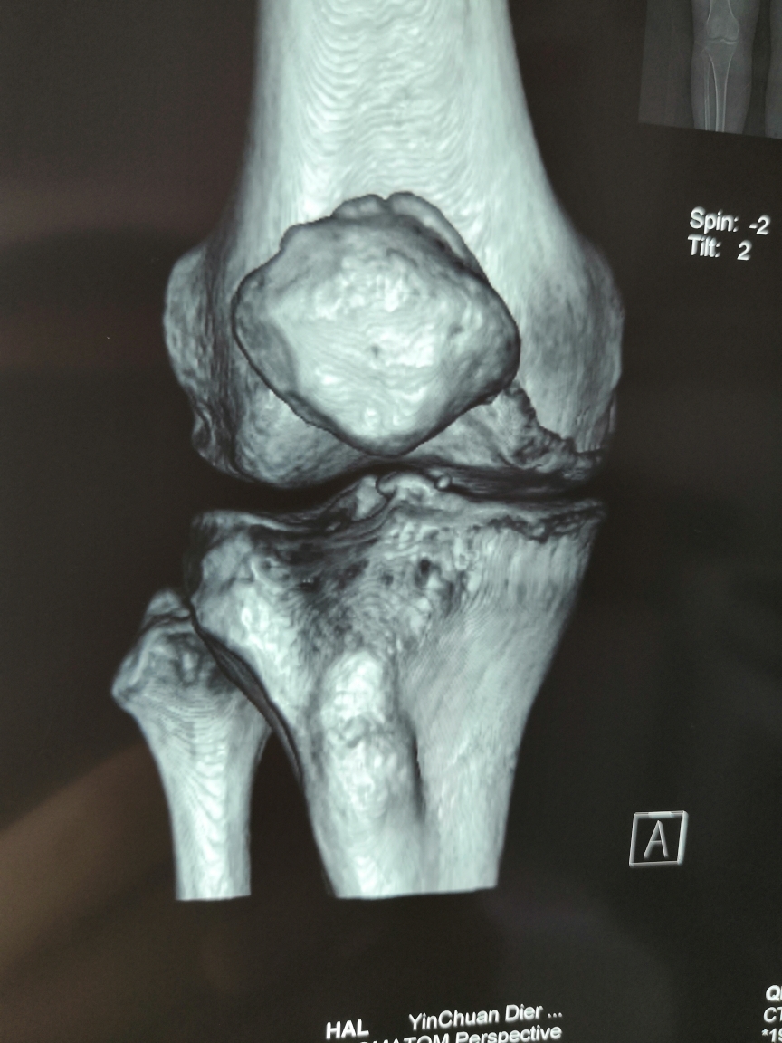ct显示病人右膝内侧关节下骨硬化,提示内侧关节软骨磨损严重