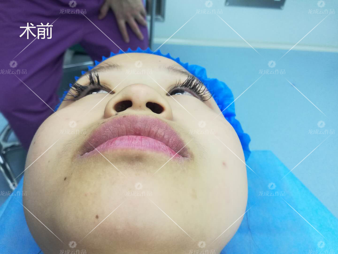 可联合进行鼻翼基底部分切除,鼻孔缩小术.