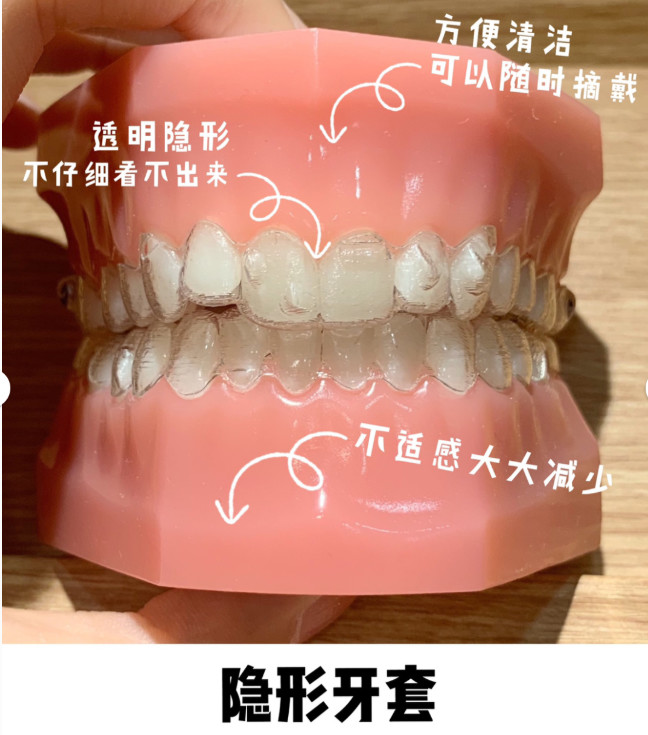 陶瓷牙套也分自鎖和非自鎖,價格介於普通牙套和隱形牙套之間.