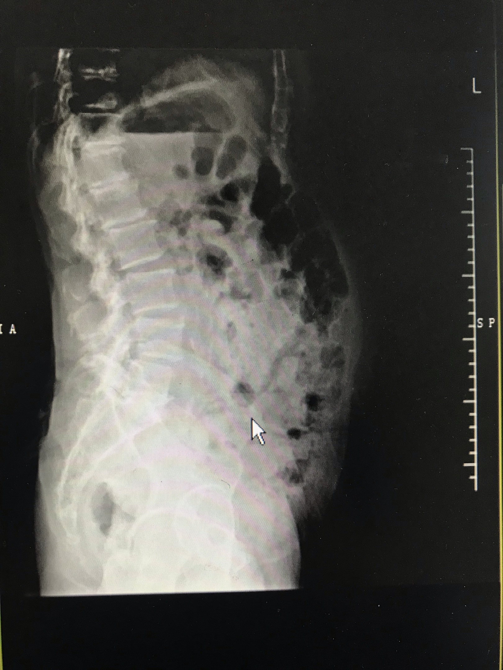 门诊腰椎正侧位片见腰4椎体滑脱