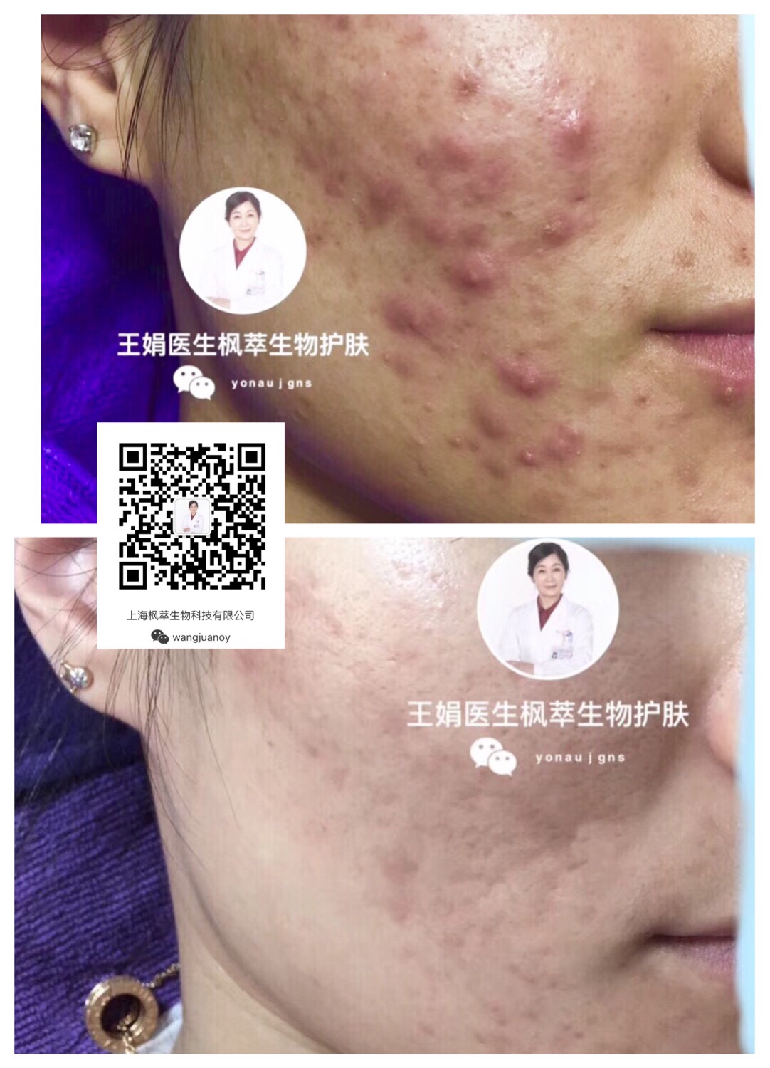 囊肿型痤疮～最严重的类型