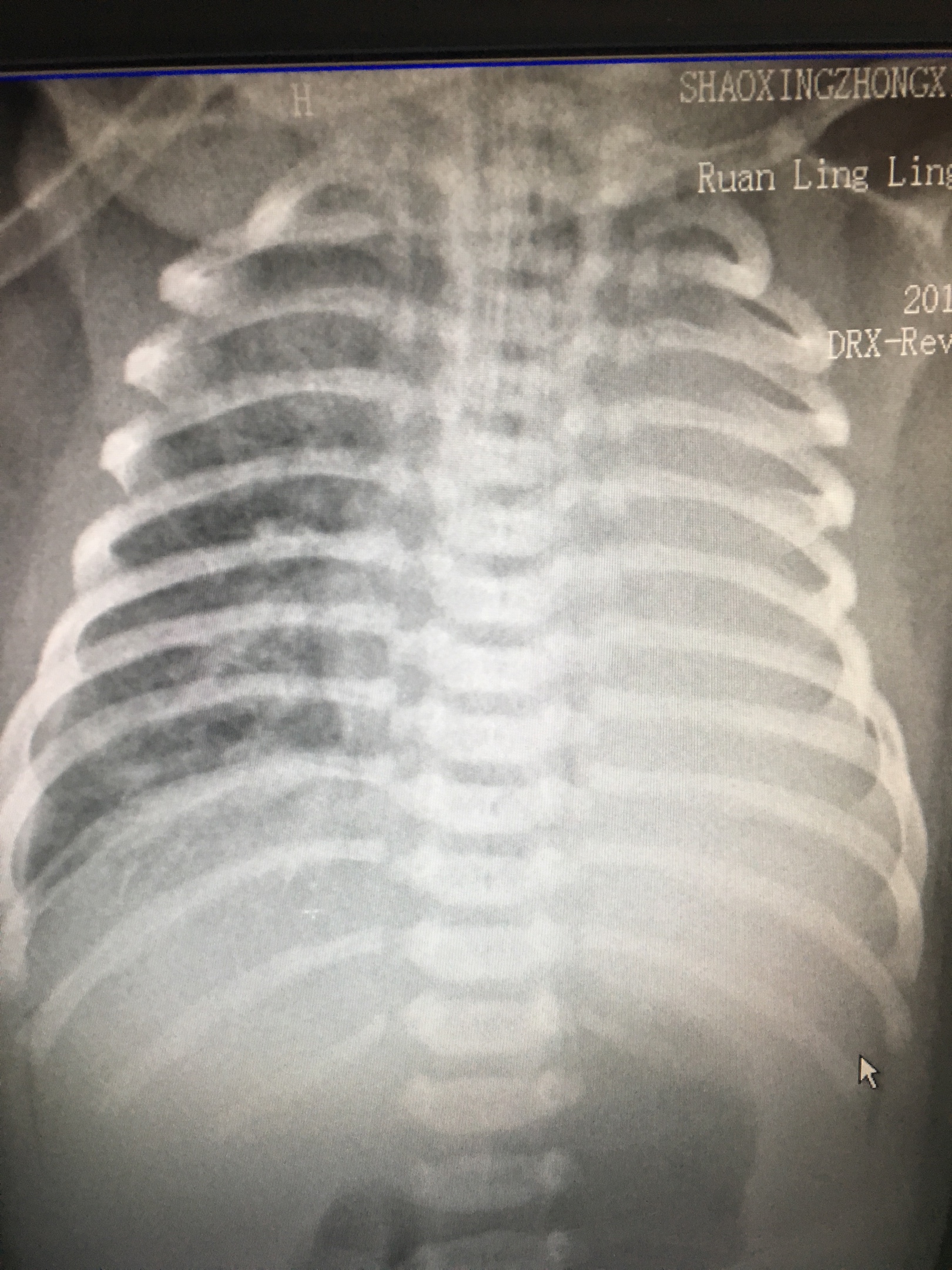 入院当天胸片,大量胎粪堵塞引起左肺肺不张