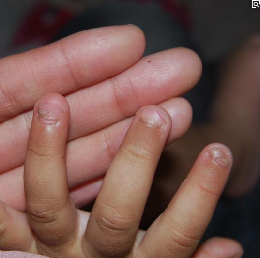 从宝宝的指甲状态,可以判断宝宝的健康状况;对,就这么简单